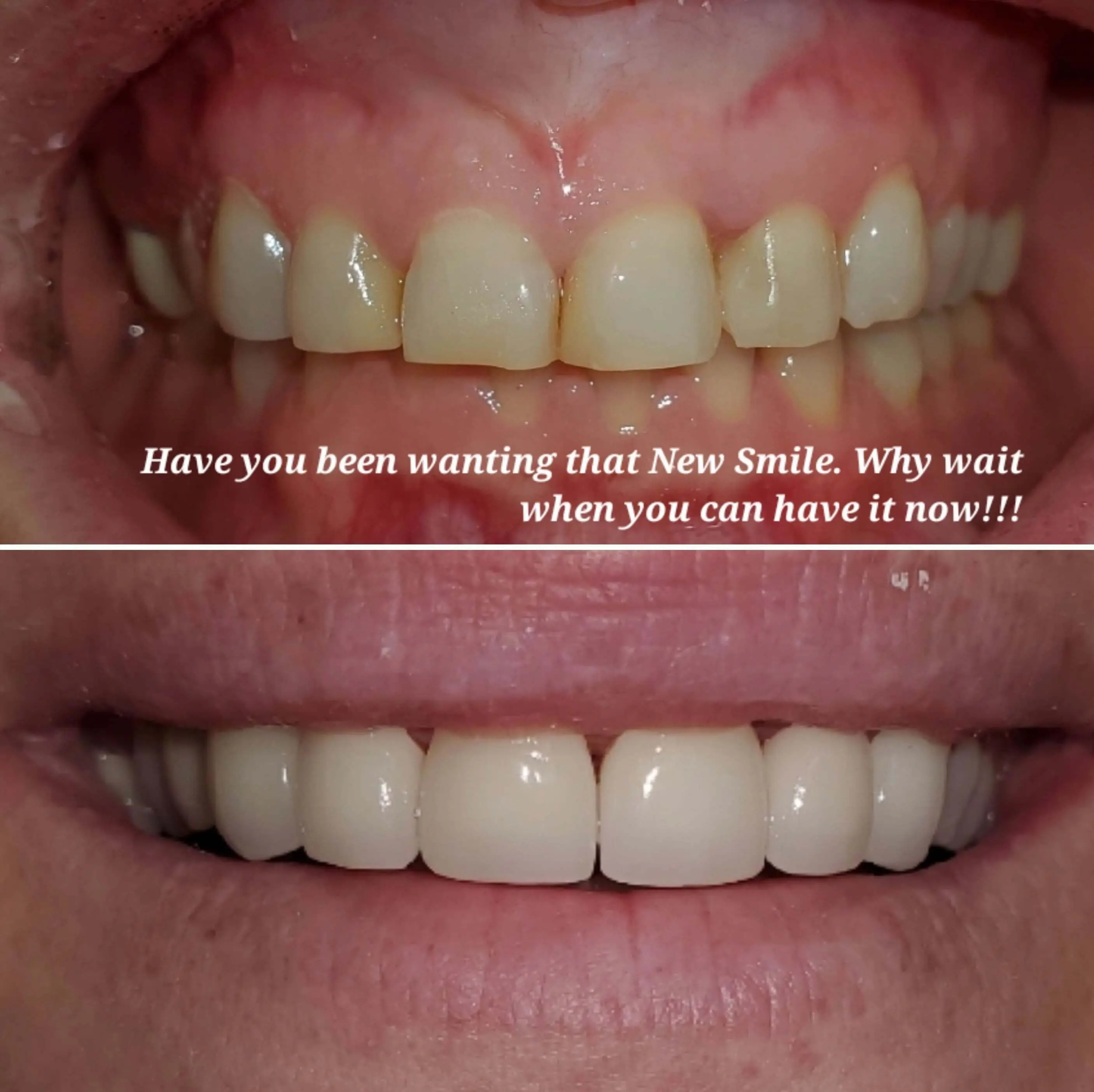 Teeth whitenign before and after