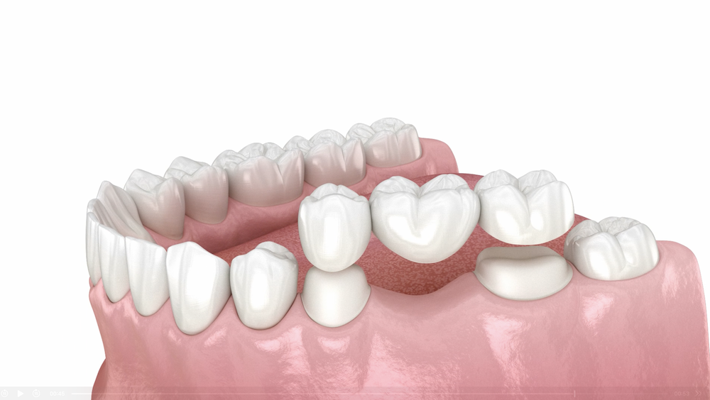 Dental bridge