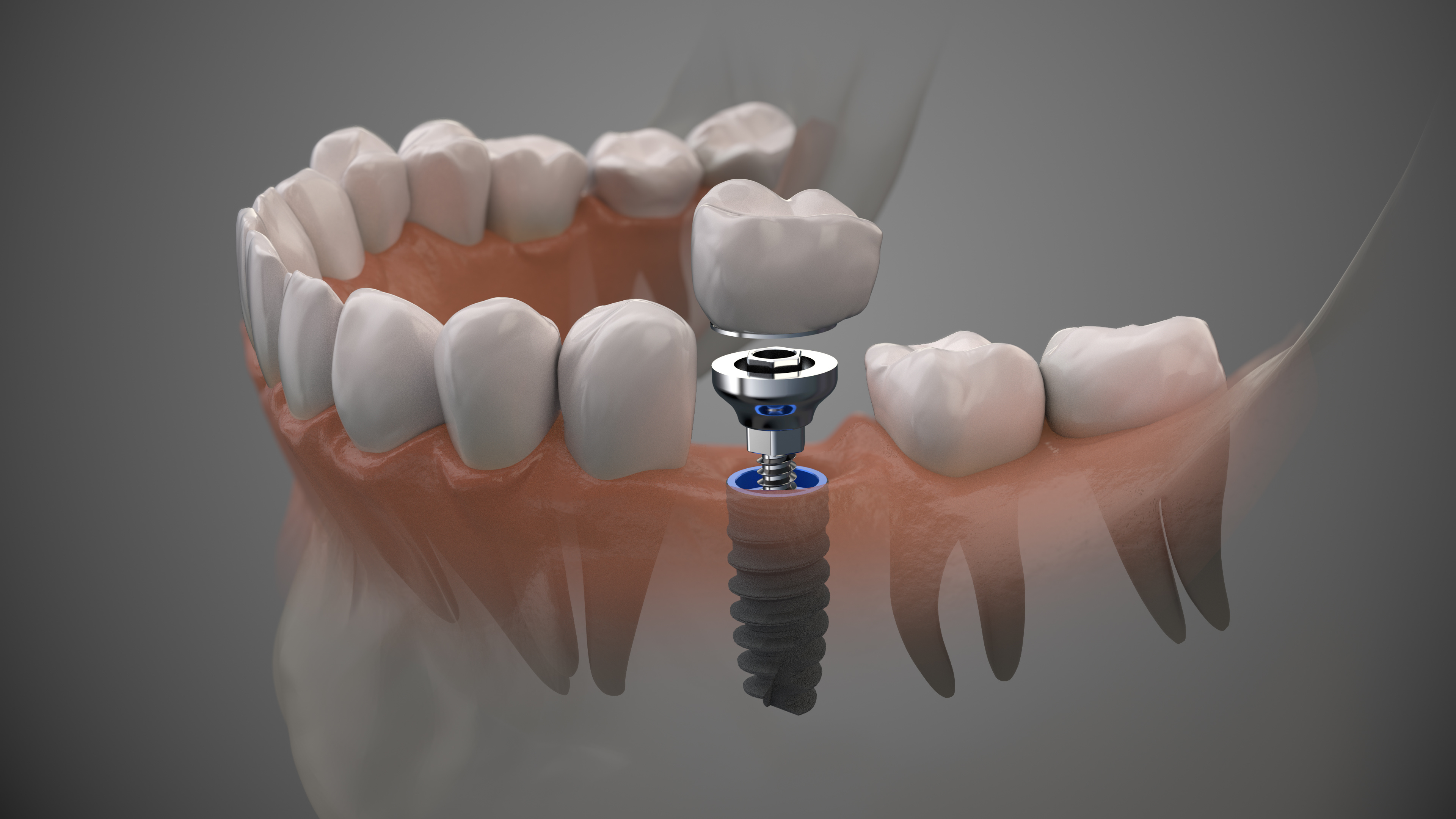 Single tooth implant