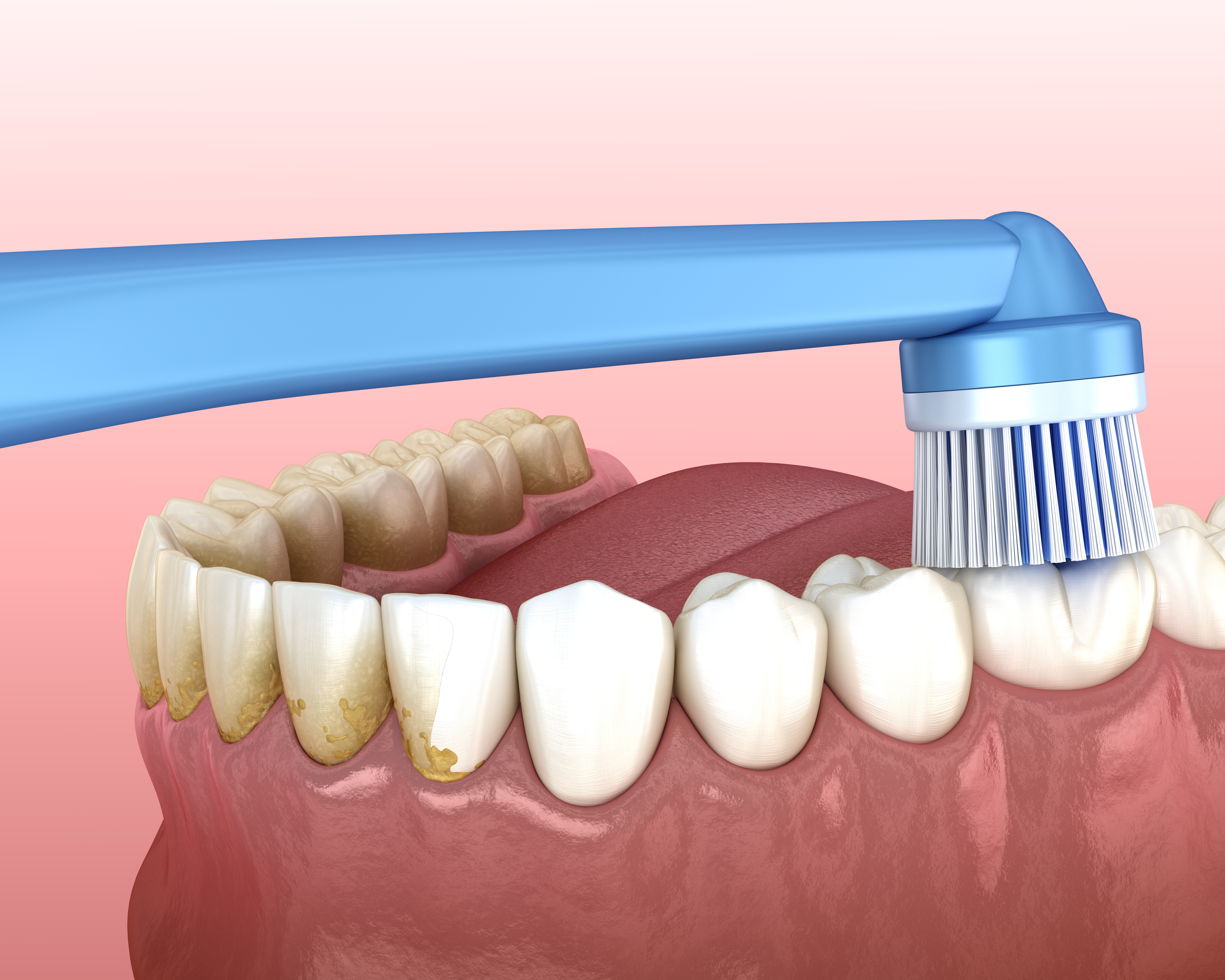 Professional dental cleaning