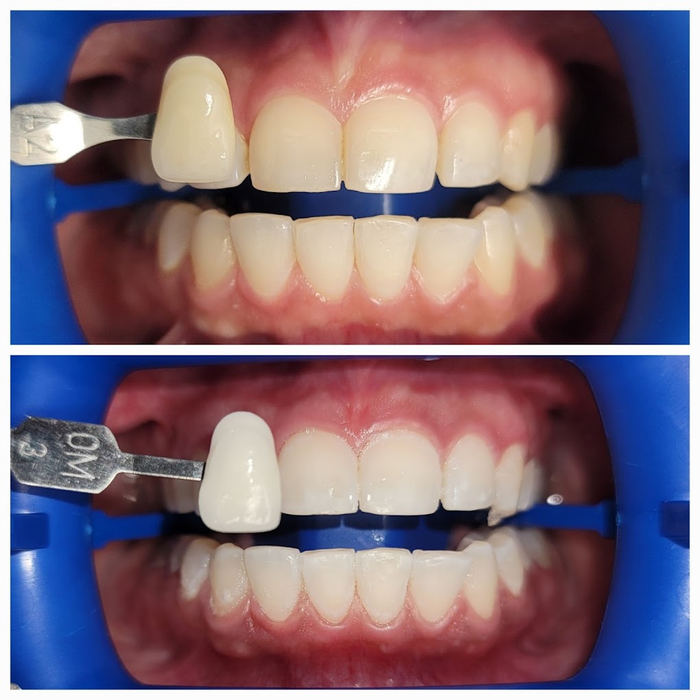 Teeth whitening results Corona CA